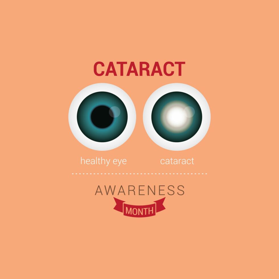 What You NEED To Know About Cataracts