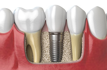 What are Dental Implants, and why do we need them?