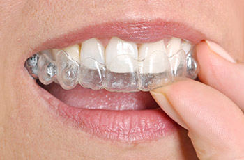  Dental Braces: Advantages of Invisalign